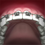 zęby w trakcie leczenia aparatem