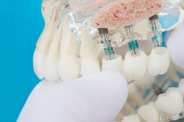 Jakie są przeciwwskazania do implantów zębowych?