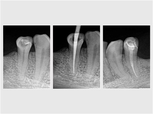 Endodoncja mikroskopowa 