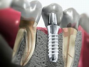 implanty w przekroju