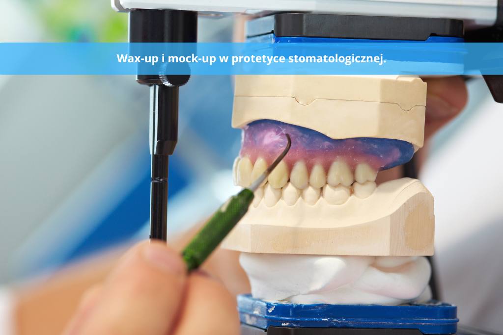 Wax-up i mock-up w protetyce stomatologicznej. Kompleksowa odbudowa zwarcia.