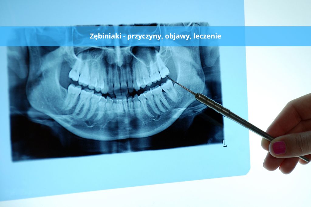 Zębiniaki – przyczyny, objawy, leczenie